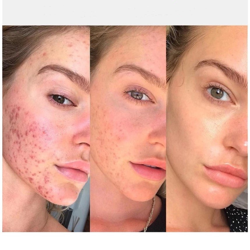 Aparat Electroderm Cosmetic 4 în 1 – Tratament Anti - Acnee, Riduri, Sebum și Îngrijire Ten - BUZ.RO